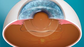 Warum ist Augenlasern bekannter als die EVO Visian ICL - Dr.med. Amir-Mobarez Parasta | MUNICH EYE